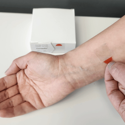 corneofix-forearm